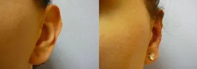 Корекція вух (Отопластика) – результат 4