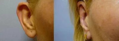 Корекція вух (Отопластика) – результат 5