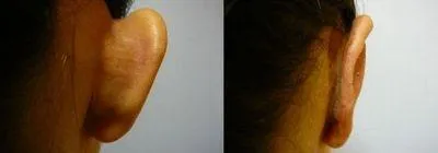 Корекція вух (Отопластика) – результат 6