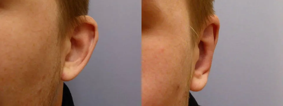 Корекція вух – Отопластика – результат 4