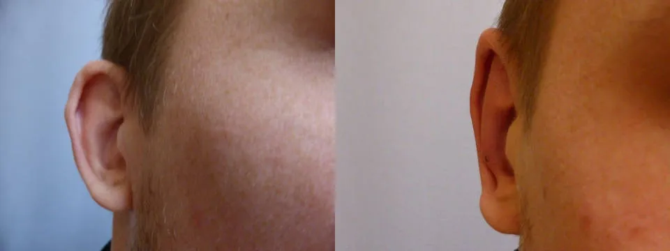 Корекція вух – Отопластика – результат 5