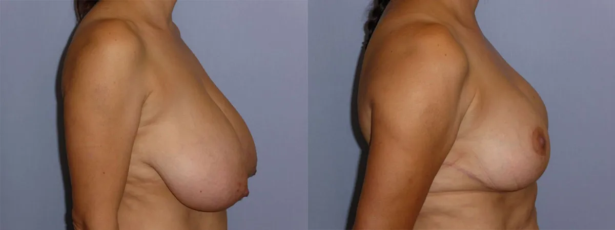 Зменшення грудей (Редукція) – результат 1