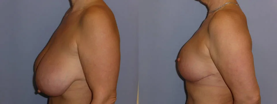Зменшення грудей (Редукція) – результат 2