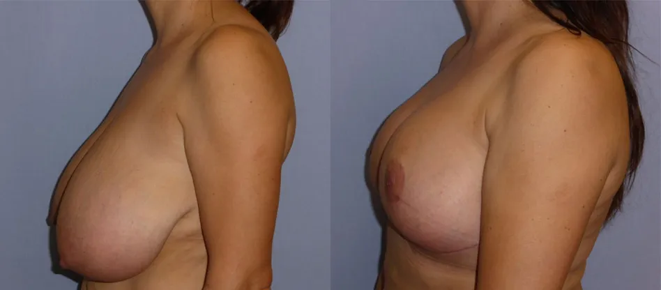 Зменшення грудей – Редукція – результат 4