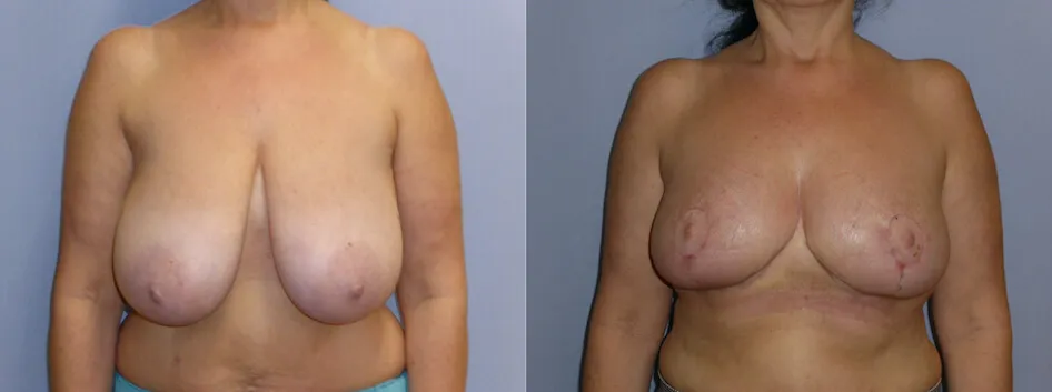 Зменшення грудей – Редукція – результат 5