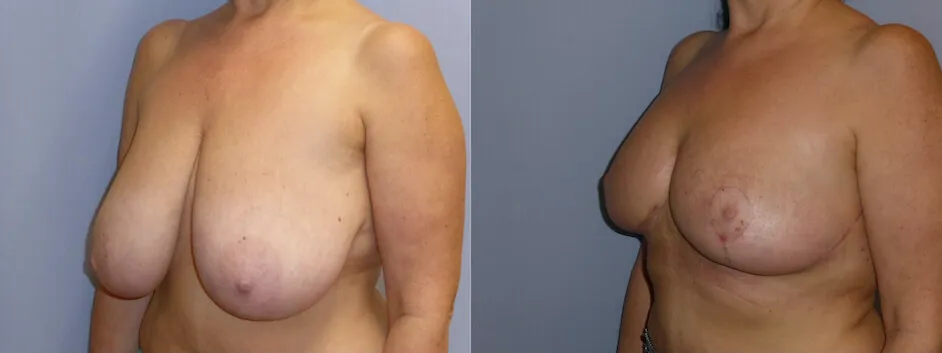Зменшення грудей (Редукція) – результат 3