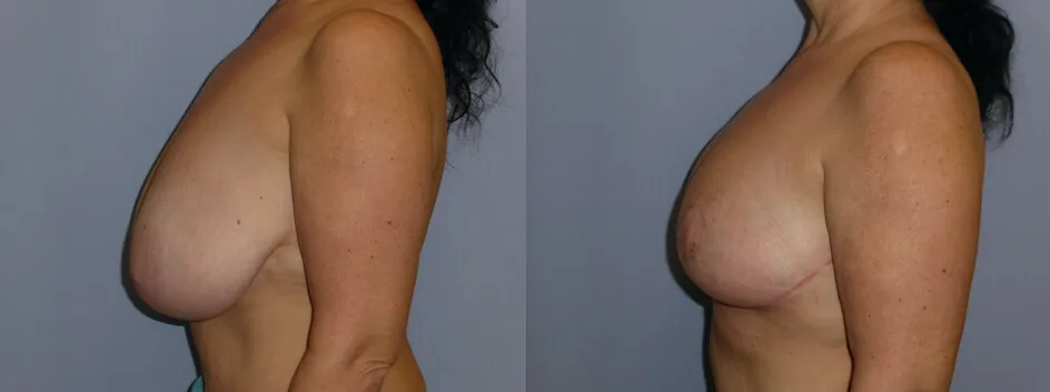Зменшення грудей – Редукція – результат 7