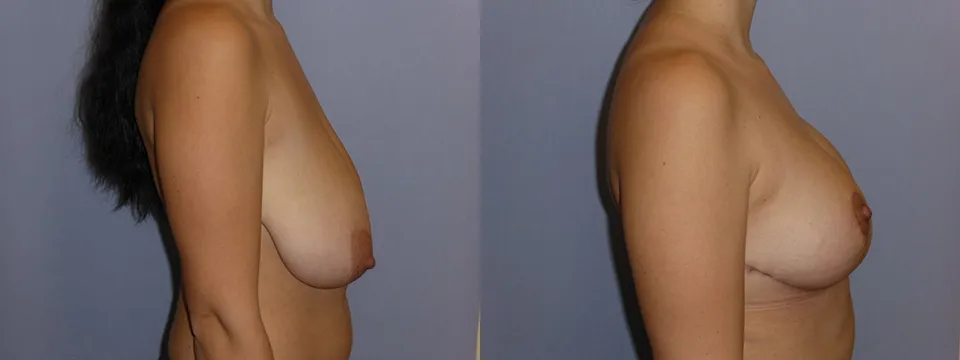 Зменшення грудей (Редукція) – результат 4