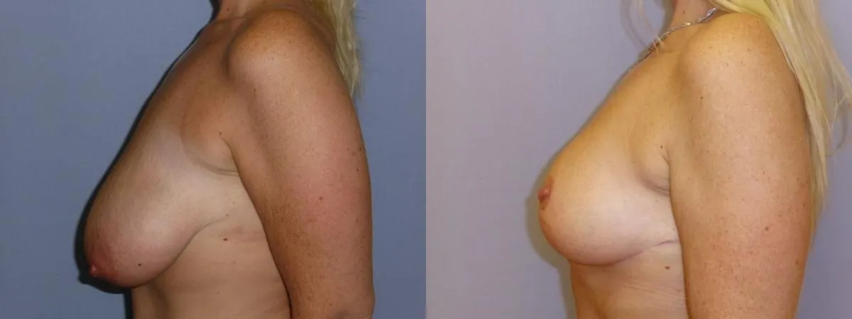 Зменшення грудей – Редукція – результат 12