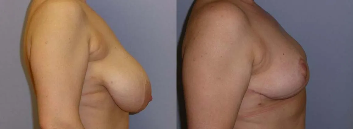 Зменшення грудей – Редукція – результат 13