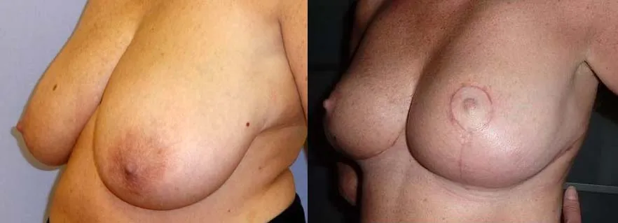 Зменшення грудей (Редукція) – результат 5