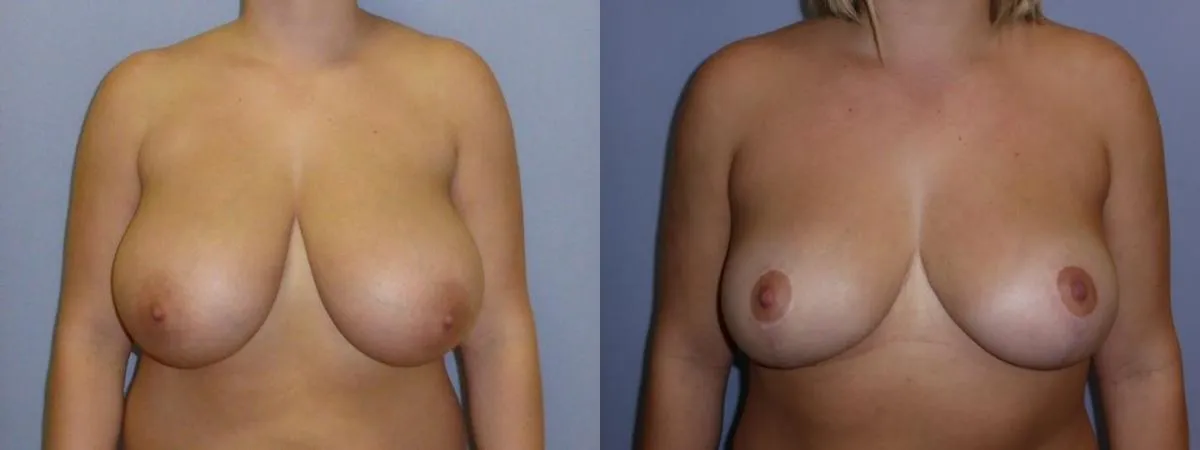 Зменшення грудей – Редукція – результат 15