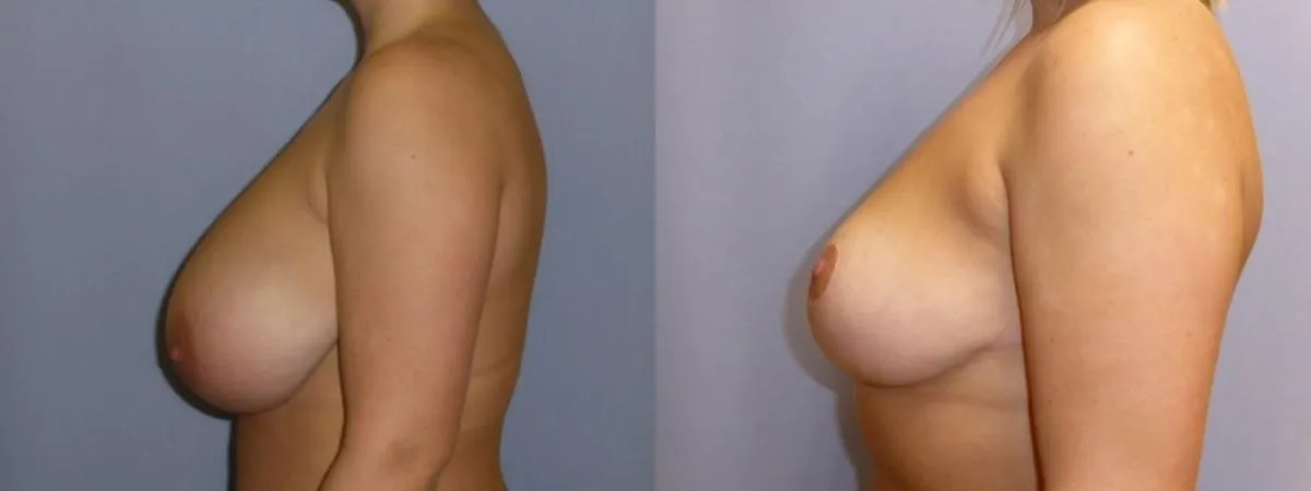 Зменшення грудей – Редукція – результат 16