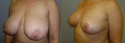 Зменшення грудей – Редукція – результат 17