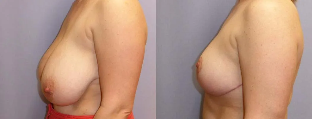 Зменшення грудей (Редукція) – результат 6