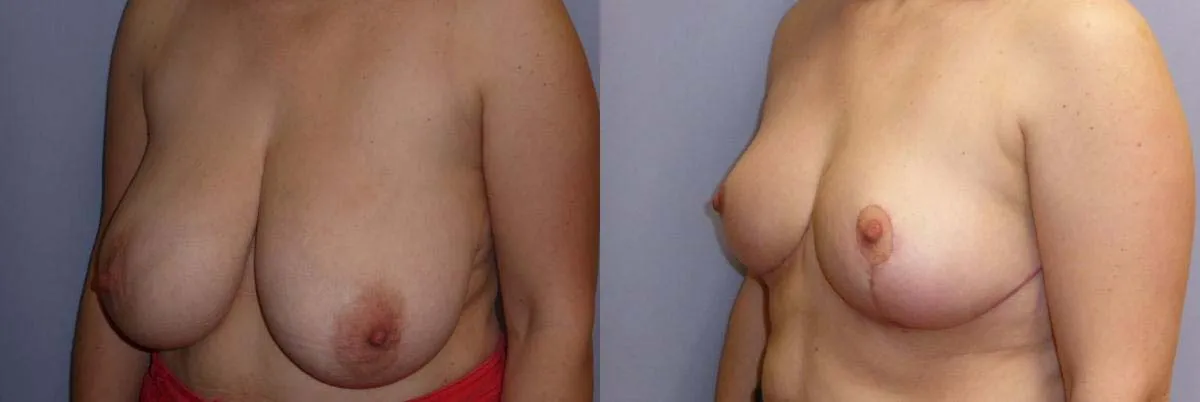 Зменшення грудей – Редукція – результат 19