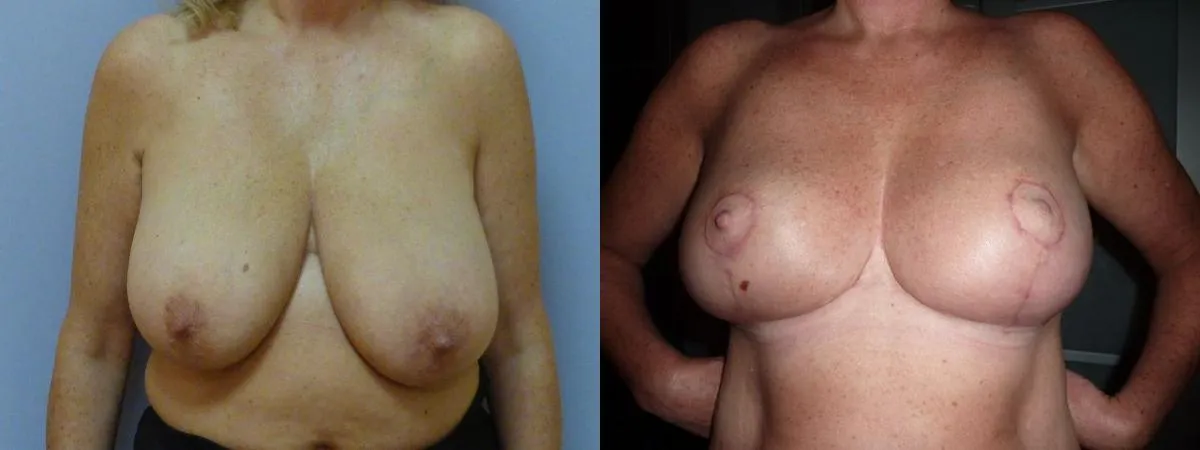 Зменшення грудей – Редукція – результат 20