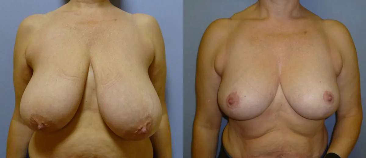 Зменшення грудей – Редукція – результат 21