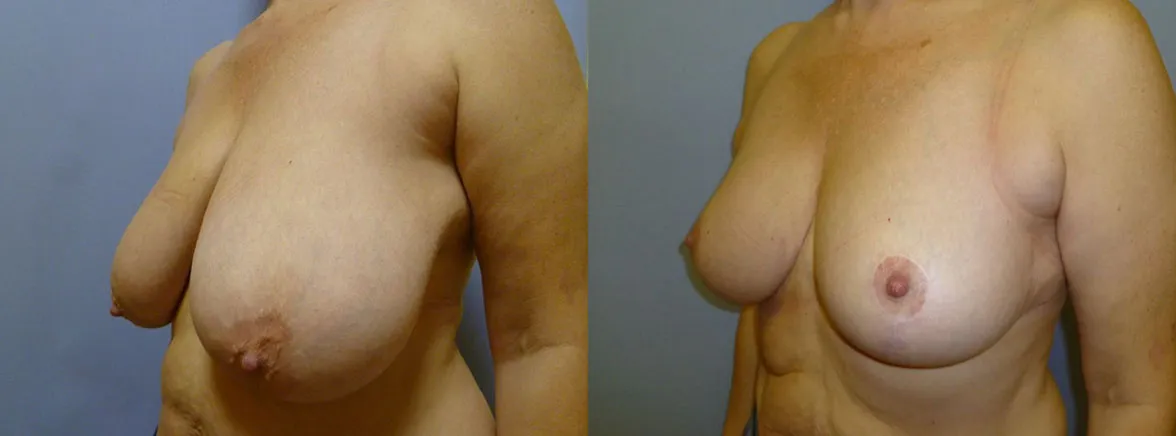 Зменшення грудей – Редукція – результат 22