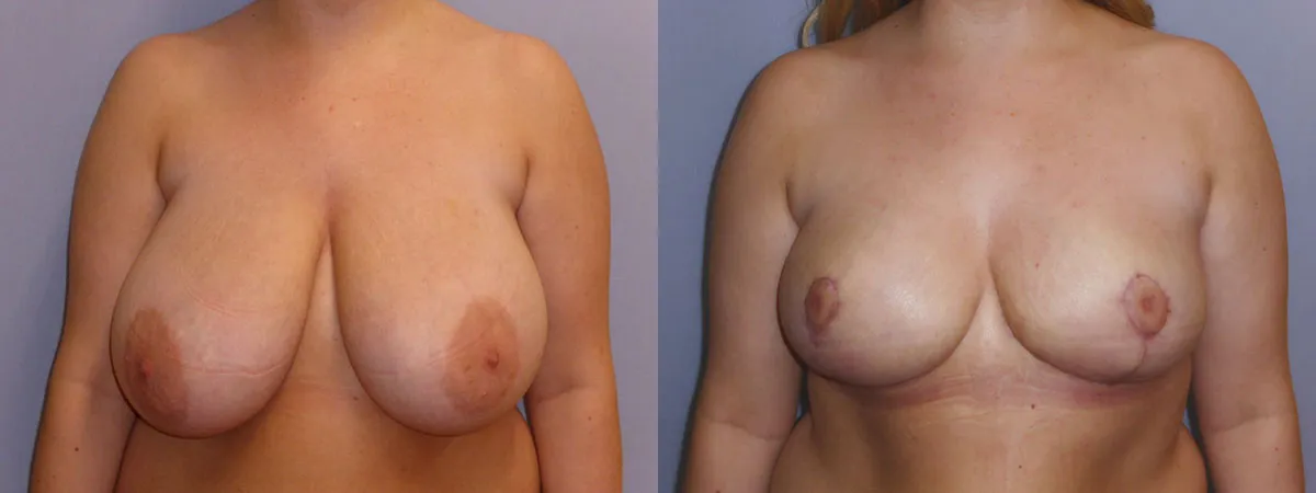 Зменшення грудей – Редукція – результат 23