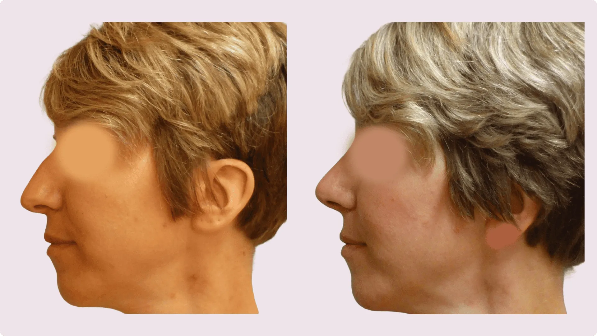 Korekce nosu (Rhinoplastika) – fotografie před a po 1