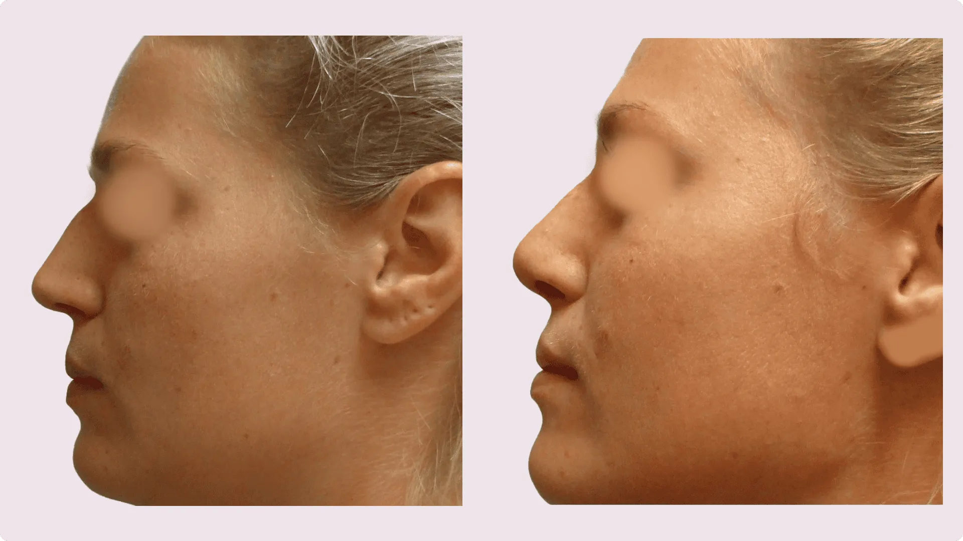 Nasenkorrektur – Rhinoplastik – Vorher-Nachher-Foto 4
