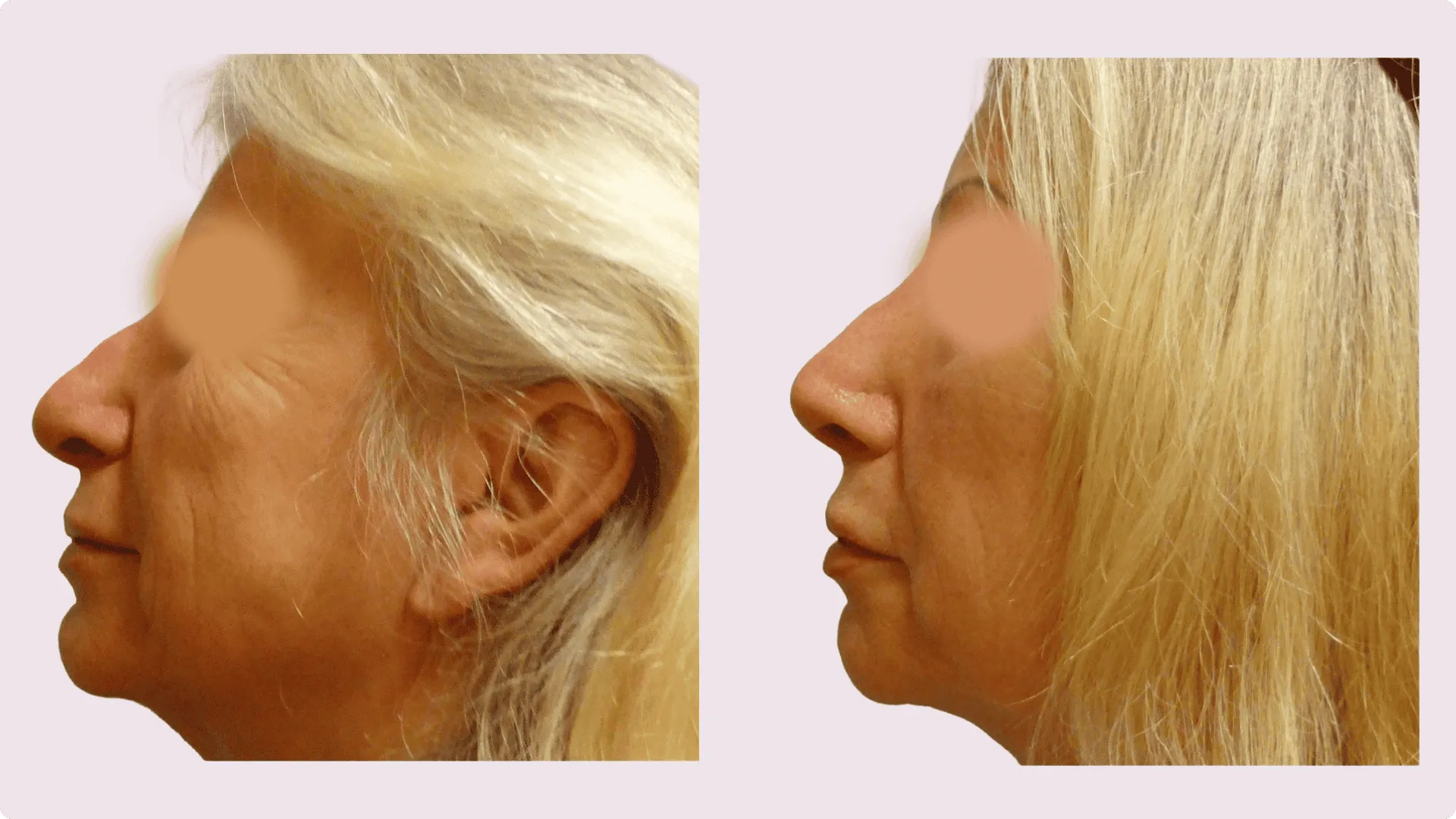 Korekce nosu (Rhinoplastika) – fotografie před a po 2