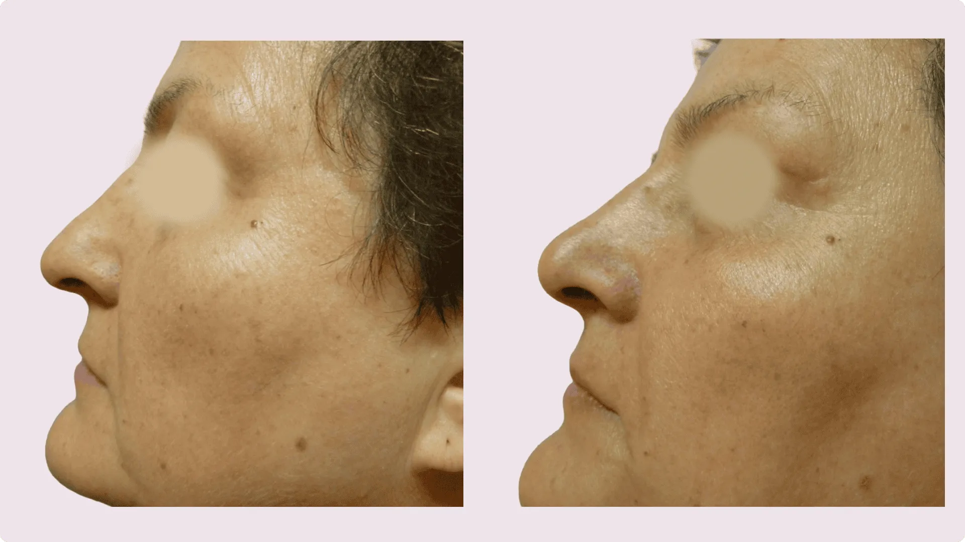 Nasenkorrektur – Rhinoplastik – Vorher-Nachher-Foto 5