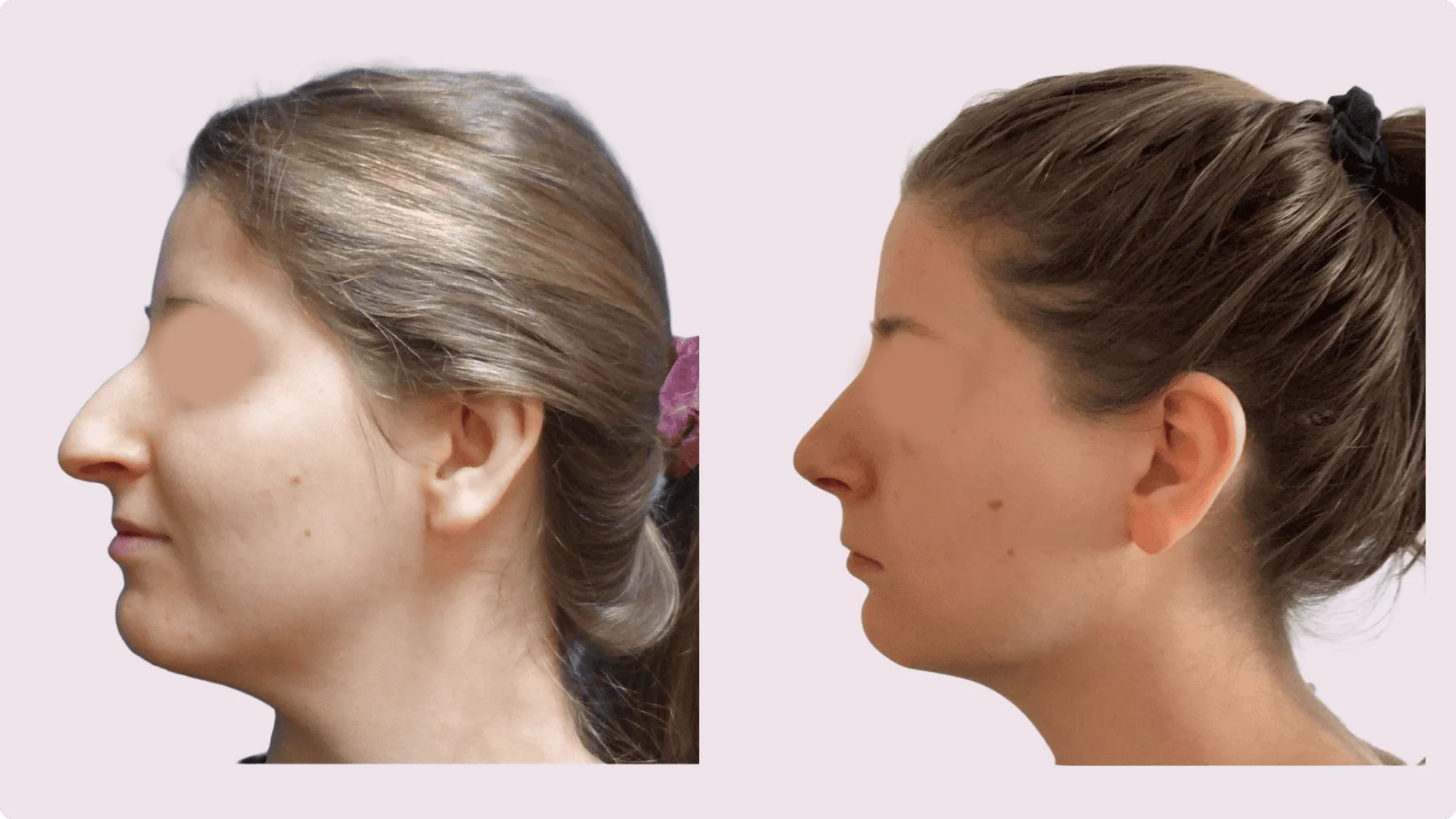 Korekce nosu (Rhinoplastika) – fotografie před a po 3