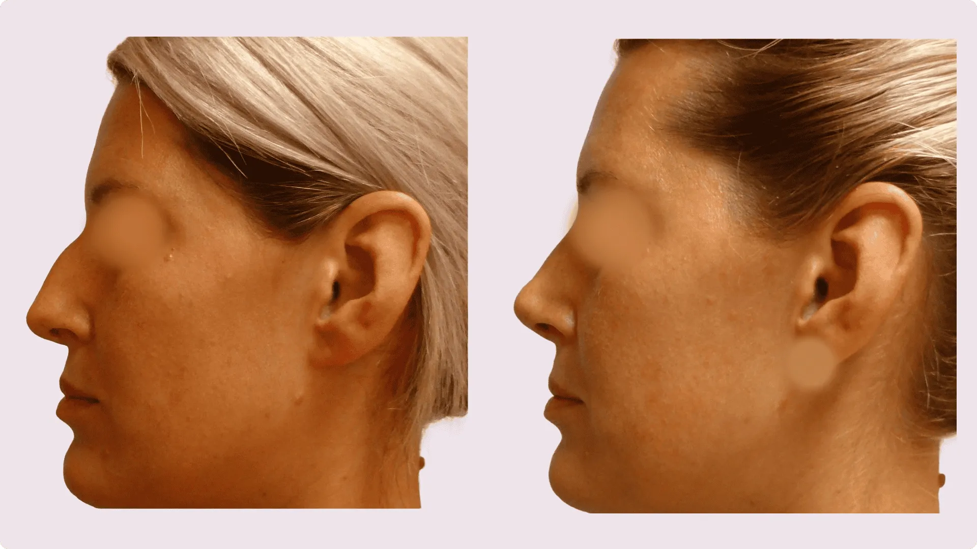 Nasenkorrektur – Rhinoplastik – Vorher-Nachher-Foto 6
