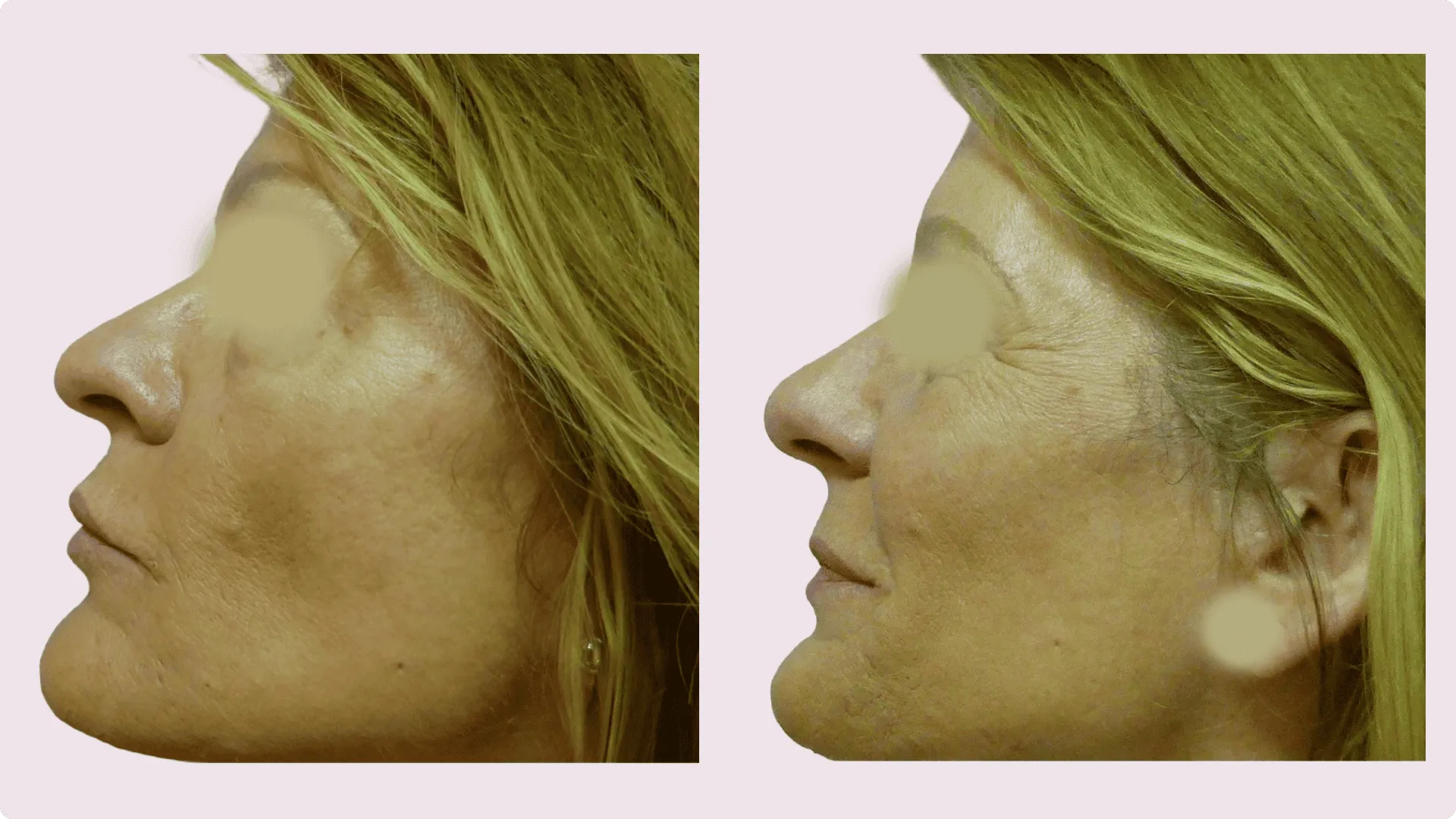 Korekce nosu (Rhinoplastika) – fotografie před a po 4