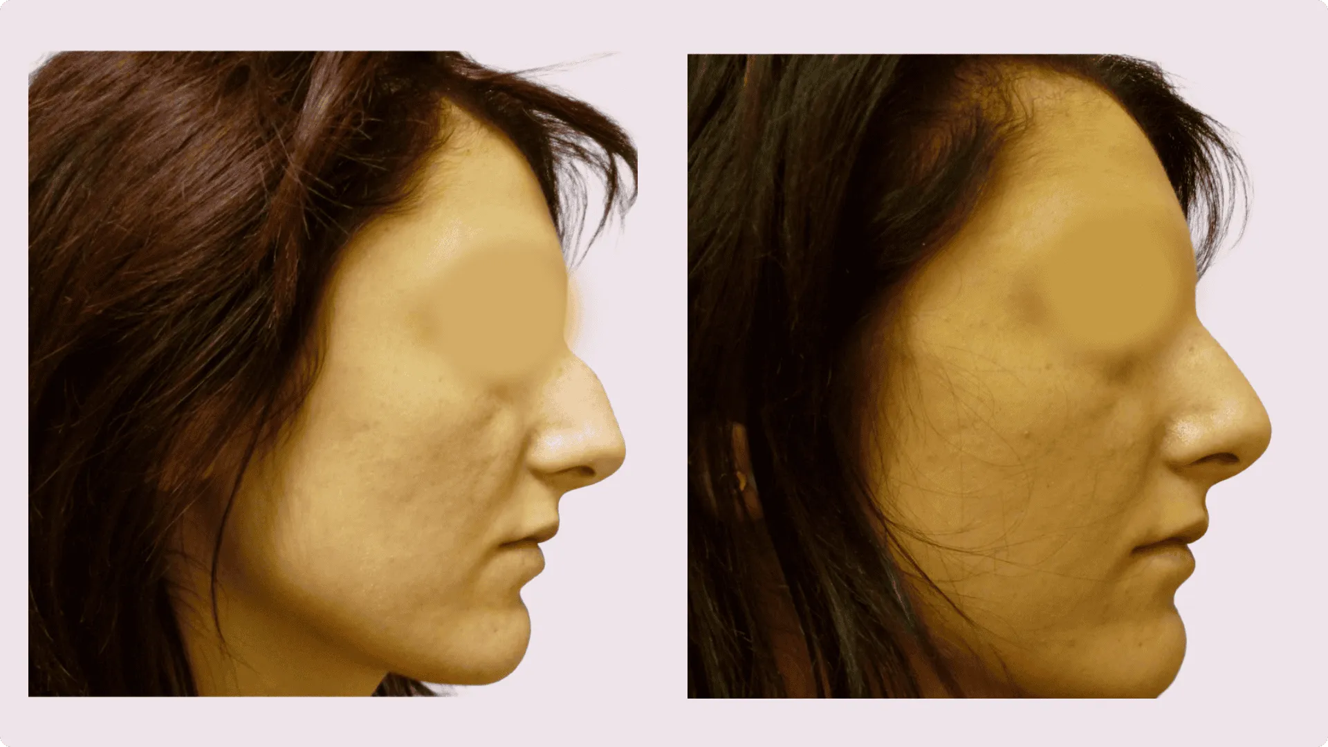 Nose Reshaping – Rhinoplasty – before and after photo 5
