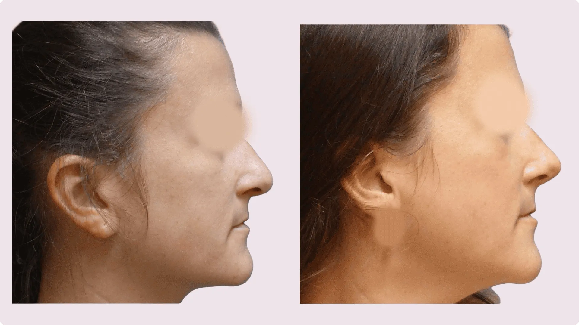 Korekce nosu (Rhinoplastika) – fotografie před a po 5