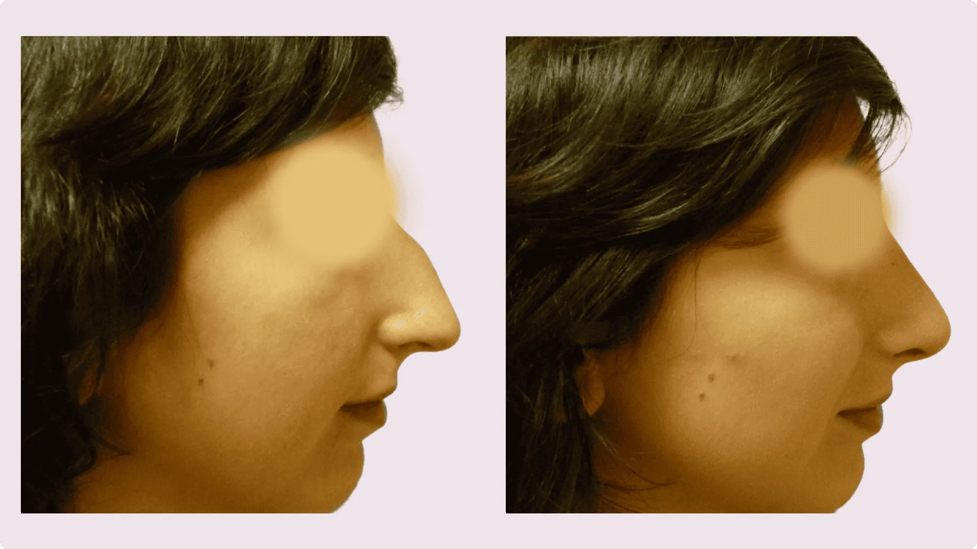Nose Reshaping – Rhinoplasty – before and after photo 7