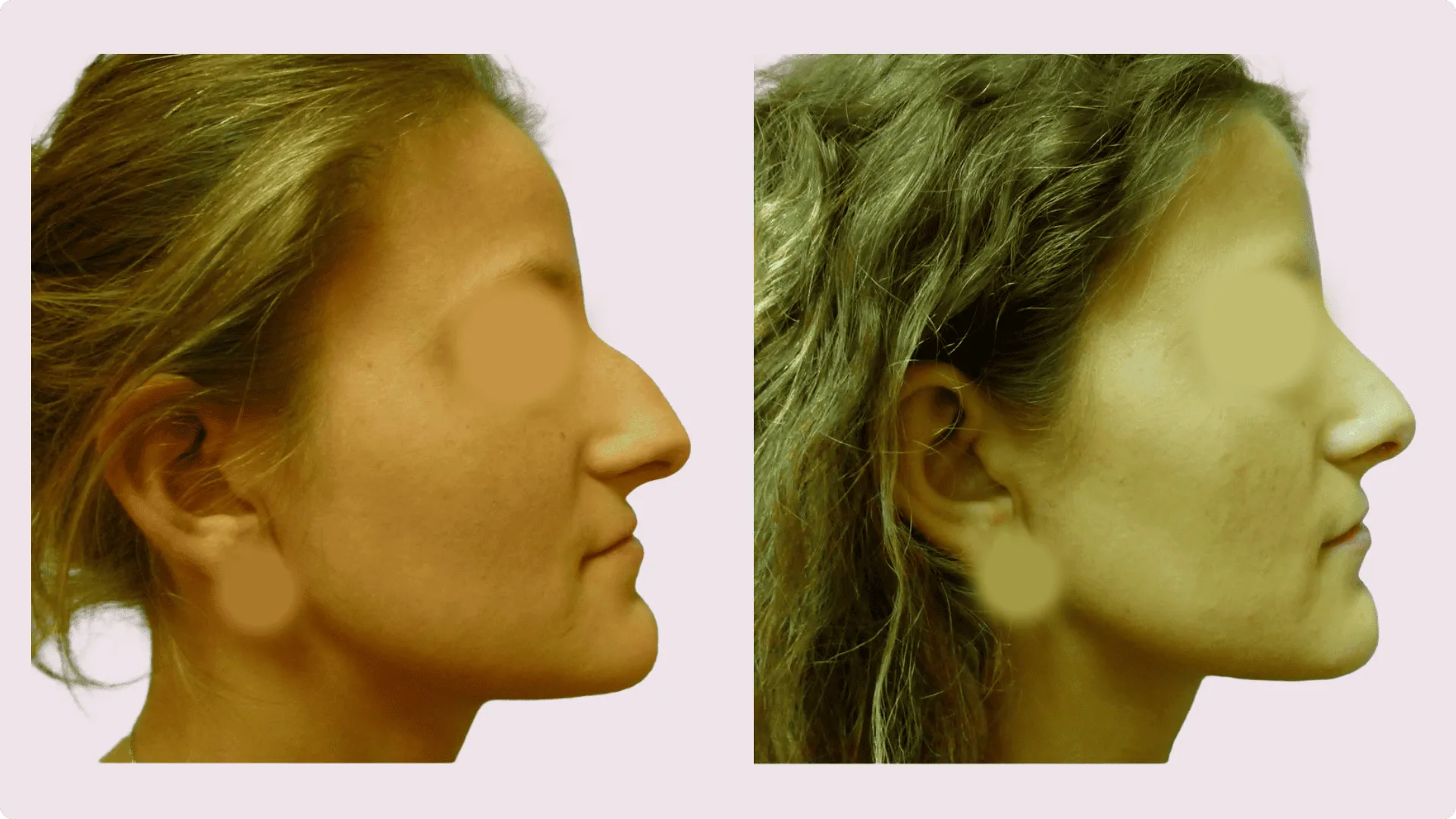 Korekce nosu (Rhinoplastika) – fotografie před a po 6
