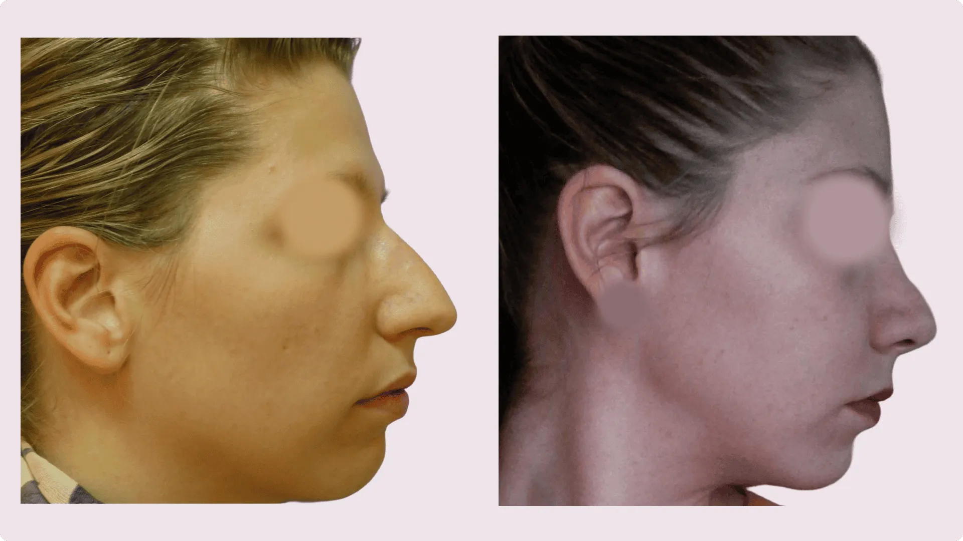 Nose Reshaping – Rhinoplasty – before and after photo 9