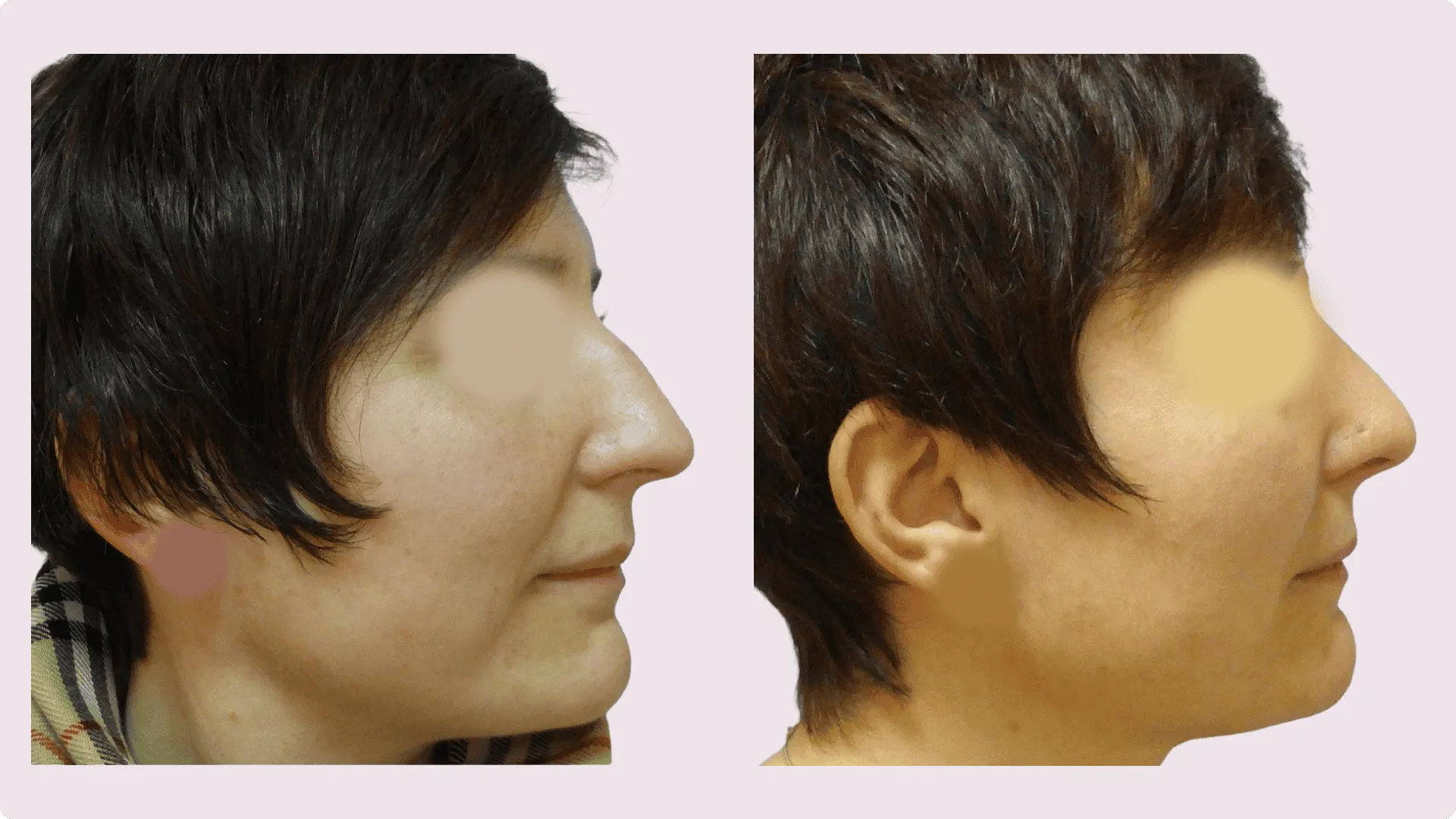 Nose Reshaping – Rhinoplasty – before and after photo 10