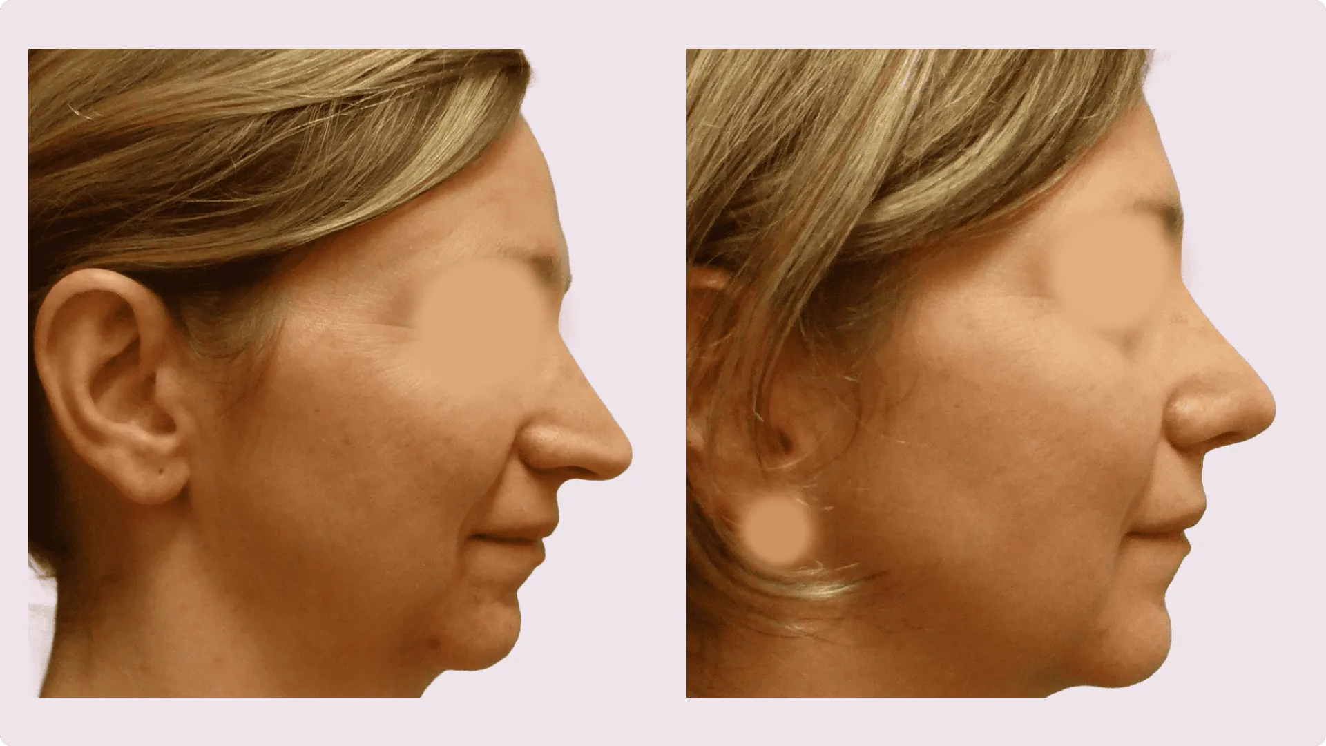 Nose Reshaping – Rhinoplasty – before and after photo 11