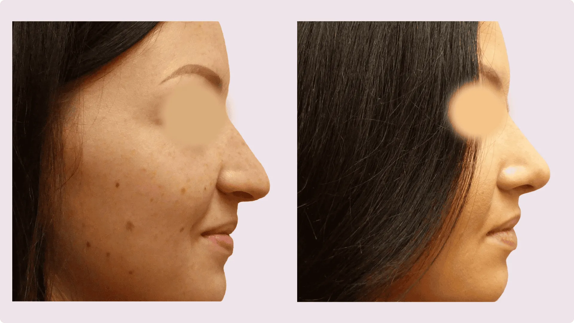 Nose Reshaping – Rhinoplasty – before and after photo 12