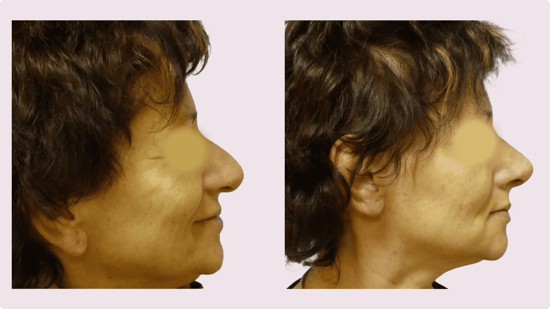 Nose Reshaping – Rhinoplasty – before and after photo 13
