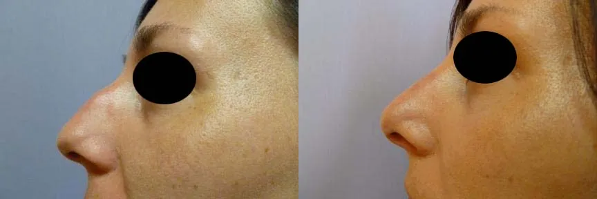 Корекція носа (Ринопластика) – результат 1