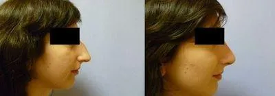 Корекція носа (Ринопластика) – результат 2