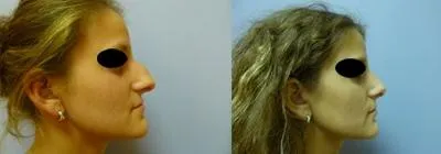 Корекція носа – Ринопластика – результат 4