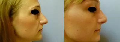 Корекція носа – Ринопластика – результат 5