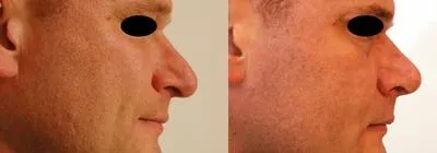 Корекція носа (Ринопластика) – результат 3