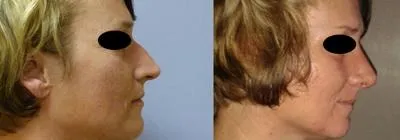 Корекція носа – Ринопластика – результат 7