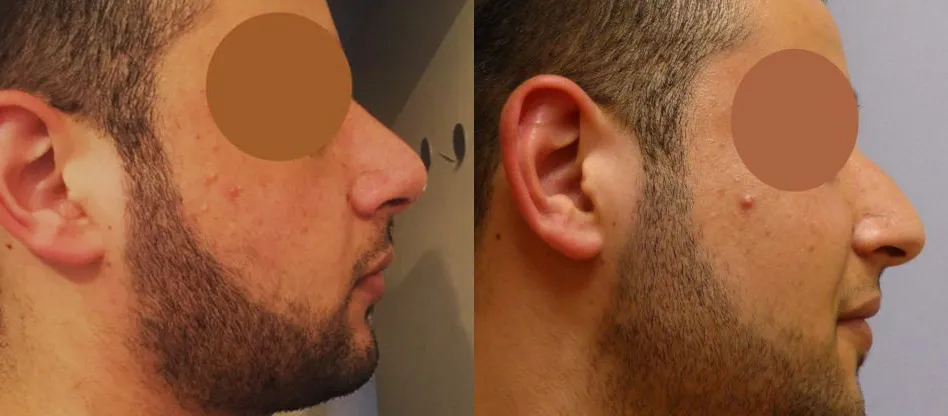 Корекція носа – Ринопластика – результат 8