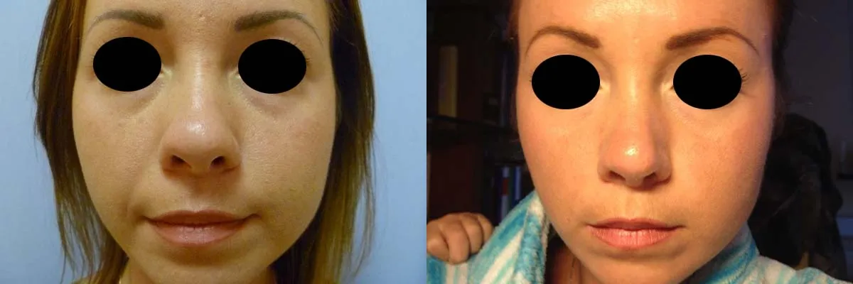 Корекція носа – Ринопластика – результат 9