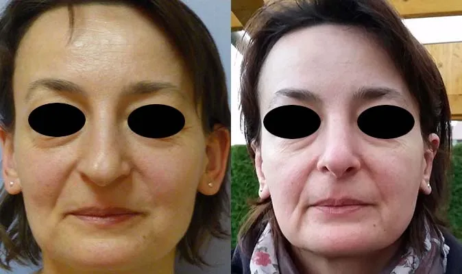 Корекція носа (Ринопластика) – результат 4