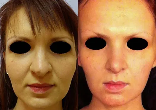 Корекція носа – Ринопластика – результат 11